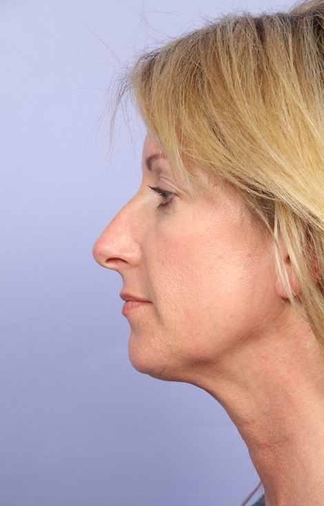 Nose Reshaping before and after photo