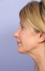 Nose Reshaping Before and after photo