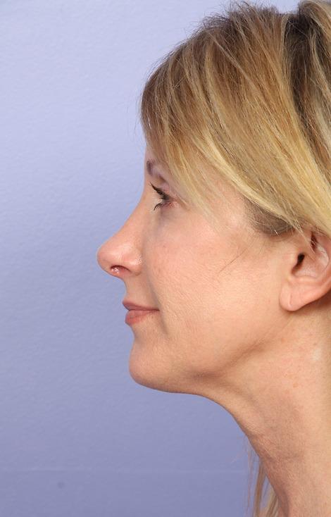 Nose Reshaping before and after photo