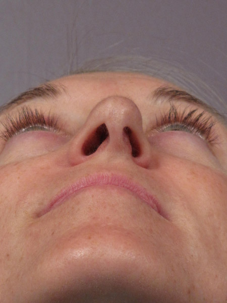 Nose Reshaping before and after photo