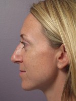 Nose Reshaping Before and after photo