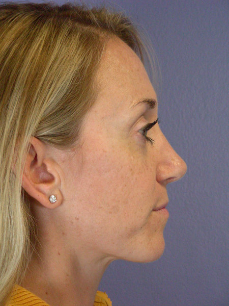 Nose Reshaping before and after photo