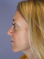 Nose Reshaping Before and after photo