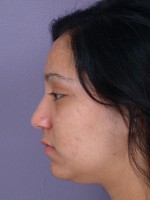 Nose Reshaping Before and after photo