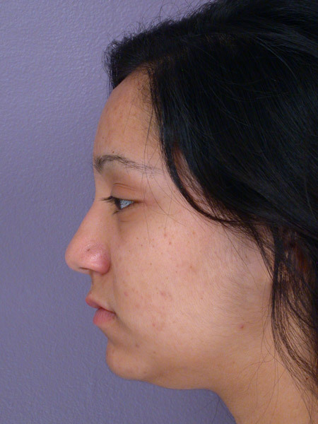 Nose Reshaping before and after photo