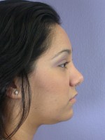 Nose Reshaping Before and after photo