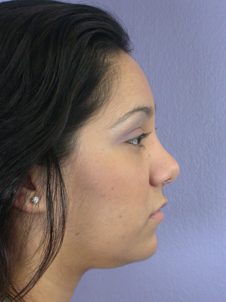 Nose Reshaping before and after photo