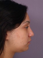 Nose Reshaping Before and after photo