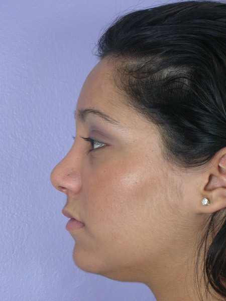 Nose Reshaping before and after photo