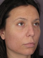 Nose Reshaping Before and after photo