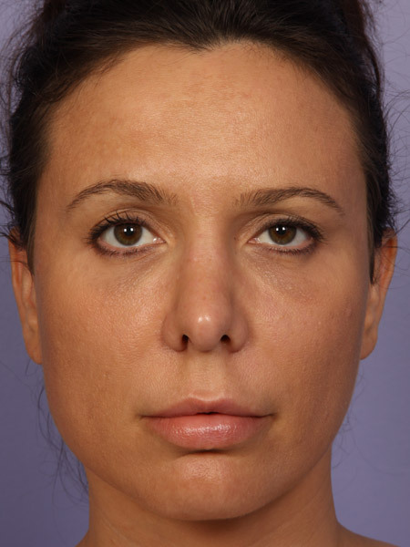 Nose Reshaping before and after photo