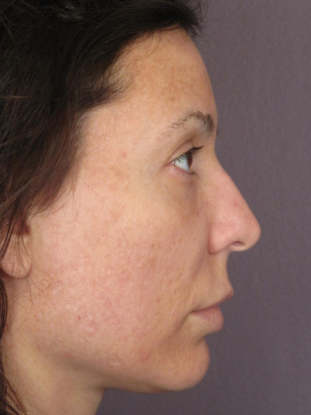 Nose Reshaping before and after photo