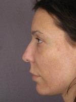 Nose Reshaping Before and after photo