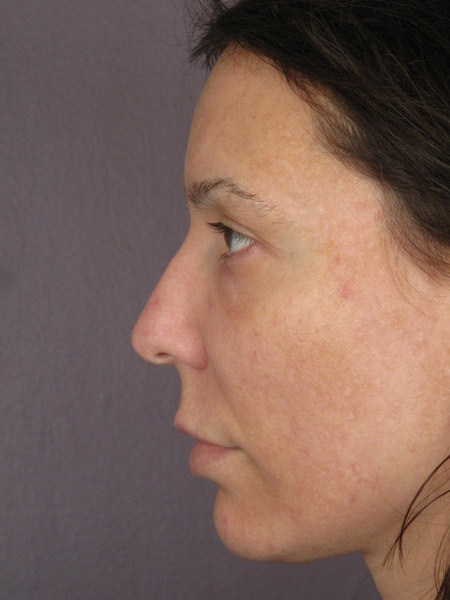 Nose Reshaping before and after photo