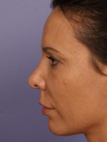 Nose Reshaping Before and after photo