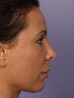 Nose Reshaping Before and after photo