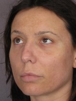 Nose Reshaping Before and after photo