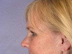 Nose Reshaping Before and after photo