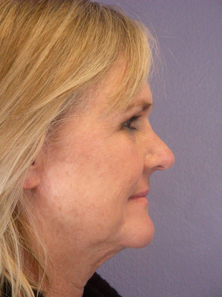 Nose Reshaping before and after photo