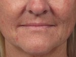 Nose Reshaping Before and after photo