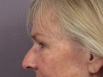 Nose Reshaping Before and after photo