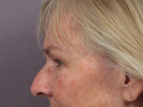 Nose Reshaping before and after photo