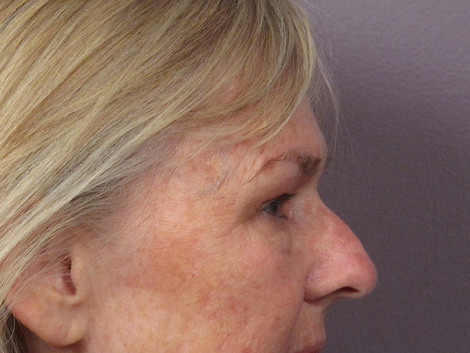 Nose Reshaping before and after photo