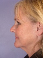 Nose Reshaping Before and after photo