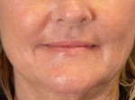 Nose Reshaping Before and after photo