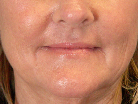 Nose Reshaping before and after photo