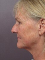 Nose Reshaping Before and after photo