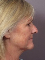 Nose Reshaping Before and after photo