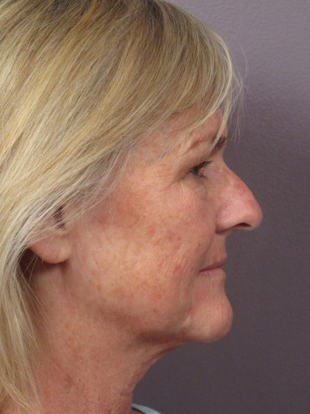 Nose Reshaping before and after photo