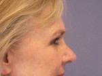 Nose Reshaping Before and after photo