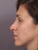 Nose Reshaping Before and after photo