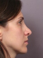 Nose Reshaping Before and after photo