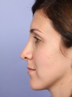 Nose Reshaping Before and after photo