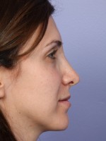 Nose Reshaping Before and after photo