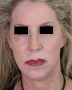 Cheek/Chin Shaping Before and after photo