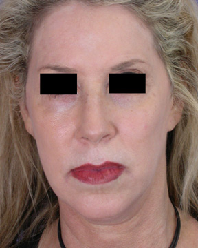 Cheek/Chin Shaping before and after photo