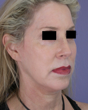 Cheek/Chin Shaping before and after photo