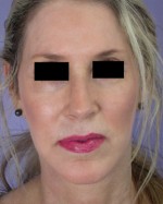 Cheek/Chin Shaping Before and after photo