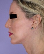 Cheek/Chin Shaping Before and after photo