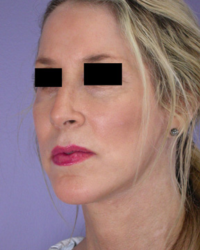 Cheek/Chin Shaping before and after photo