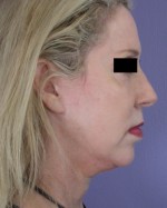 Cheek/Chin Shaping Before and after photo