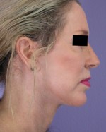 Cheek/Chin Shaping