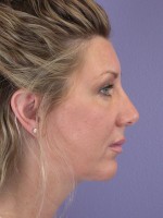 Cheek/Chin Shaping Before and after photo