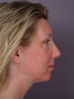 Cheek/Chin Shaping Before and after photo