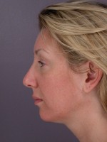 Cheek/Chin Shaping Before and after photo