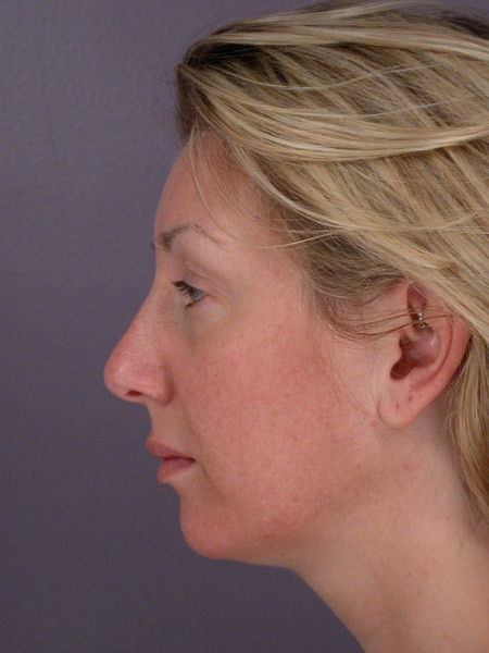 Cheek/Chin Shaping before and after photo